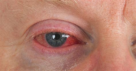 Ocular Syphilis Causes Symptoms And Treatment Obn