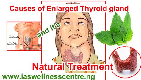 Causes Of Enlarged Thyroid Gland And Its Natural Treatment In Nigeria