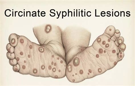 Case Of Circinate Syphilitic Lesions Reported In Nejm
