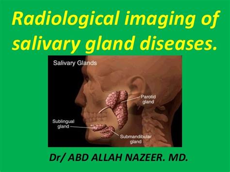 Presentation1pptx Radiological Imaging Of Salivary Glands Diseases