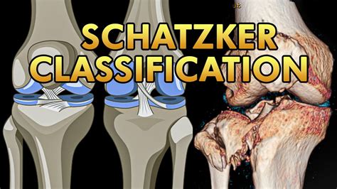 Schatzker Classification Of Tibial Plateau Fractures Youtube