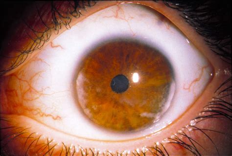 Eye Diseases 10 Common Eye Diseases