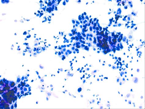 Photomicrography Of Cytological Smear Of An Invasive Ductal Carcinoma