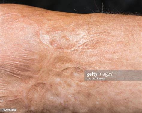 Chemical Burn Hand Photos And Premium High Res Pictures Getty Images