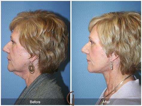 Neck Lift Before And After Photos Patient 113 Dr Kevin Sadati