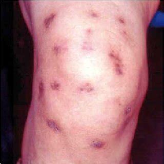 Erythematous Papules And Nodular Lesions Some With Superficial Download Scientific Diagram