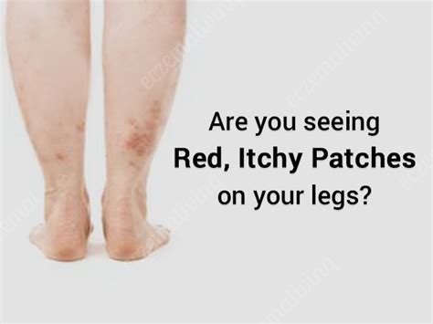 Stasis Dermatitis Eczema On Legs Causes And Treatment