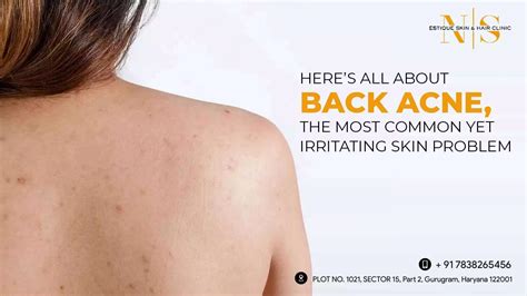 How To Get Rid Of Back Acne Causes Treatments And Tips