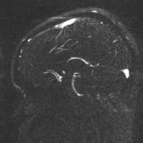 Cerebral Arteriovenous Malformation Image