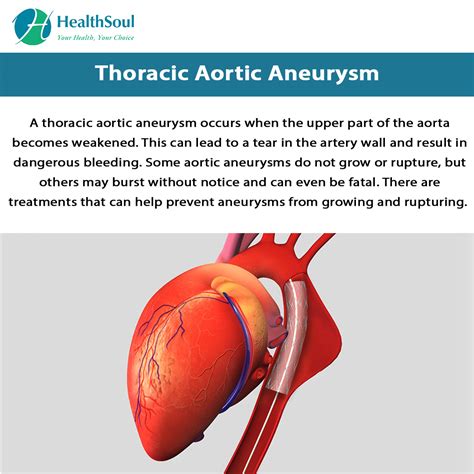 Thoracic Aortic Aneurysm Vascular Surgery Healthsoul