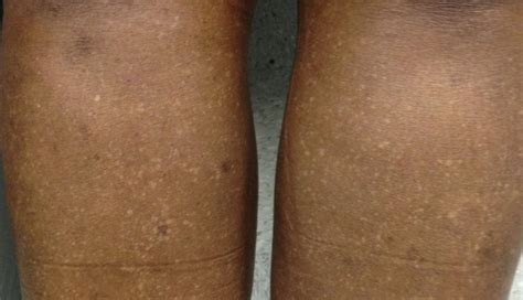 Derm Dx White Spots On The Legs Clinical Advisor