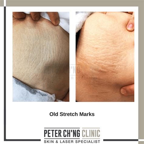 Patient Mailbox How To Treat Stretch Marks And C Sec Scars Peter Ch