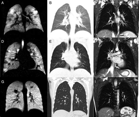 Detection Of Early Subclinical Lung Disease In Children With Cystic