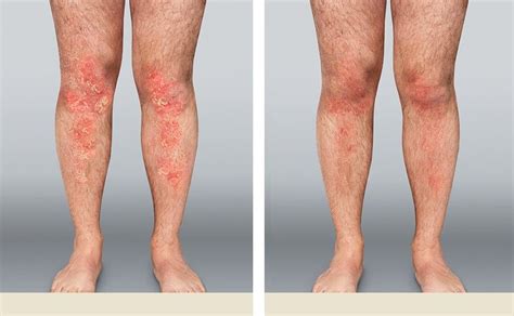 Plaque Psoriasis Pictures Before And After Humira® Use Psoriasis
