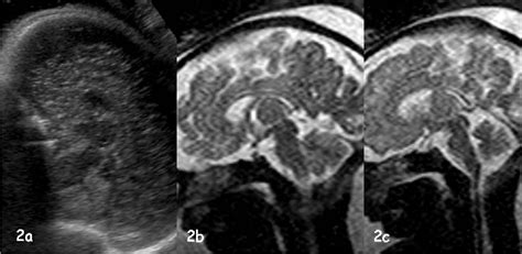Figure 1 From Fetal Cerebral Imaging Ultrasound Vs Mri An Update