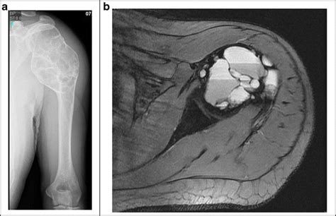Aneurysmal Bone Cyst Of The Proximal Humerus A Ap X Ray Humerus Download Scientific Diagram