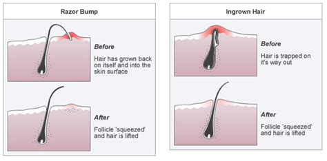 Razor Bumps And Ingrown Hair Barber Eiles Blog Barber Eile