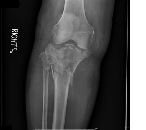 Tibial Plateau Fracture Orif