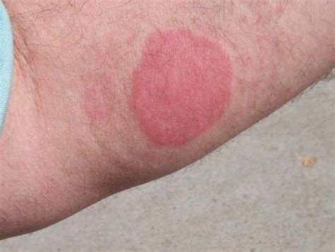 Allergic Reaction To Mosquito Bites New Health Advisor