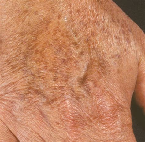 Liver Spots Pictures Causes Treatment Removal Hubpages