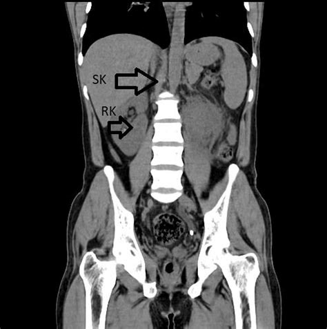 Cureus Supernumerary Kidney Triple Kidney With Horseshoe