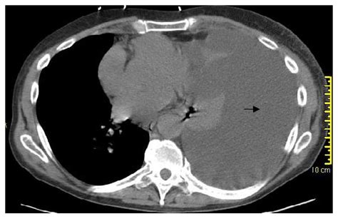 Locked Lung By Looped Hernia A Case Report Cases