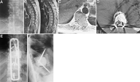 Single Stage Posterior Vertebrectomy And Replacement Combined With