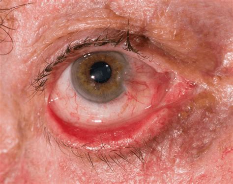Ectropion Eyelid Surgery