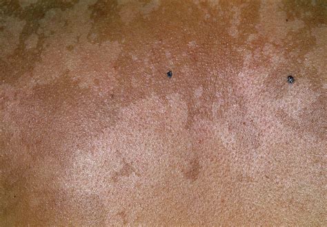 Pityriasis Versicolor Photograph By Dr P Marazzi Science Photo Library