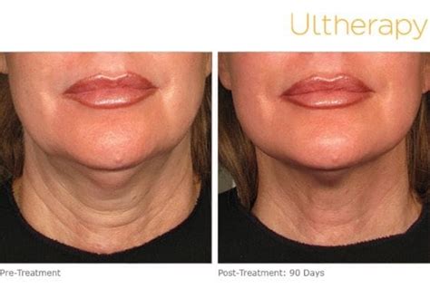 Ultherapy Before After Brows Lips Full Face Jawline Jowls Neck