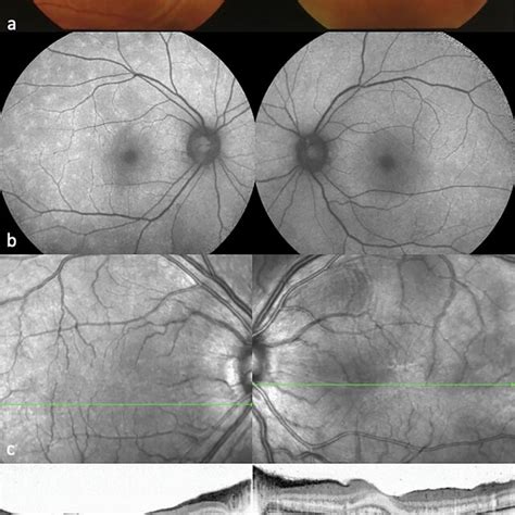 Slit Lamp Photographs Showing Diffuse Anterior Scleritis And Anterior