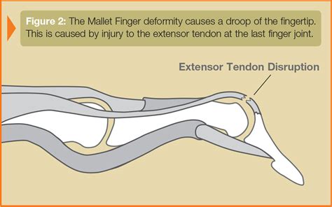 Zones Of Extensor Tendon Injury