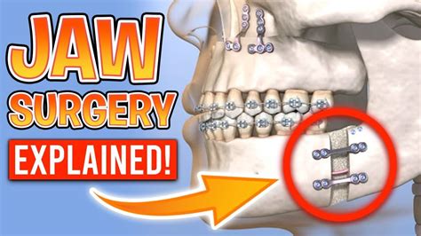 Jaw Surgery With Braces Explained Orthognathic Surgery Surgery Jaw