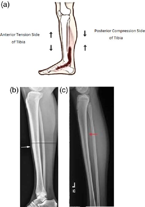 A Location Of Tibial Diaphyseal Stress Fractures B Radiograph Of