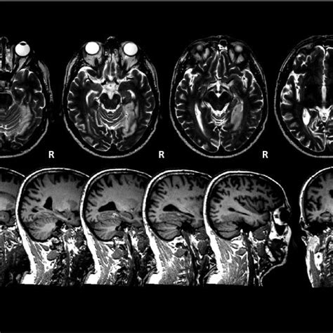 T2 Weighted Mri Top Row And T1 Weighted Mri Bottomrow Of The Stroke