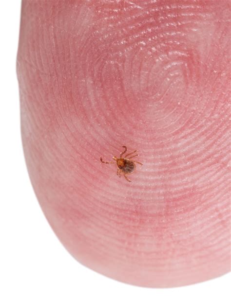 Ticks On Humans How To Remove A Tick Filmisfine