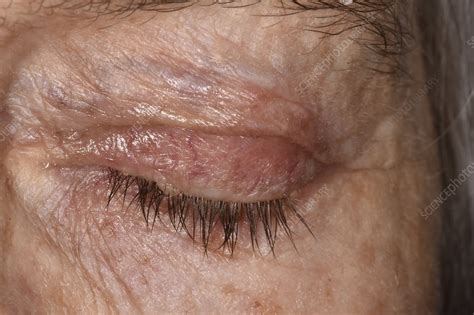 Eczema Affecting The Eyes Stock Image C0472828 Science Photo Library