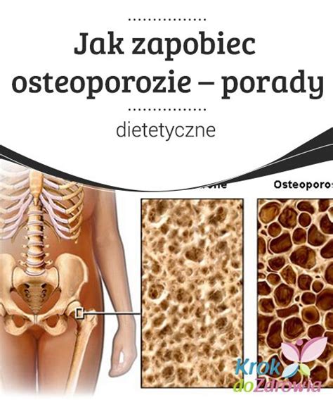 Co To Jest Osteoporoza Objawy Przyczyny I Sposoby