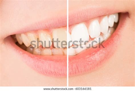 Whiten Beautiful Smile Teeth Whitening Treatment Stock Photo Edit Now