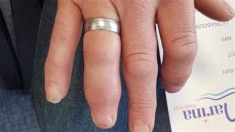 Ring Stuck On Finger Ses Help Medical Staff Get To Broken Finger At
