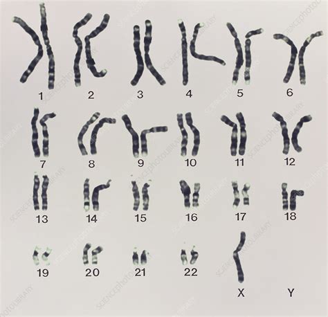 Karyotype Of Turner S Syndrome Stock Image M352 0034 Science Photo