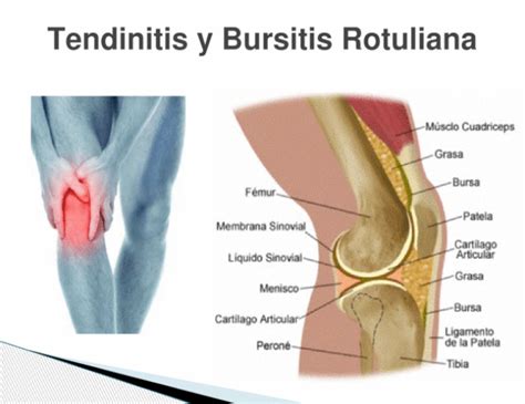Result Images Of Tratamiento Para La Bursitis Y Tendinitis Png Sexiz Pix