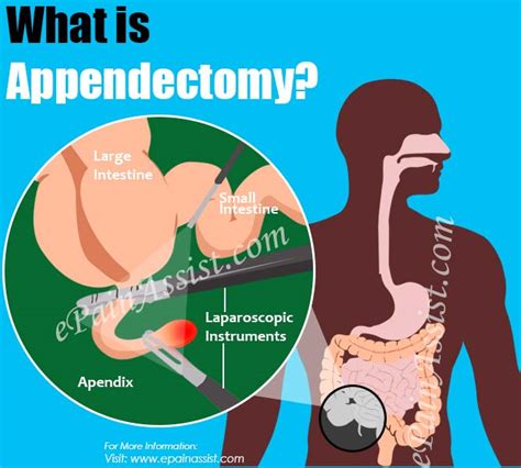 Appendicitis Appendectomy Ppt Surgery Gastroenterolog