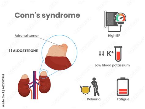 Conn S Syndrome Causes And Symptoms Vector Illustration Primary