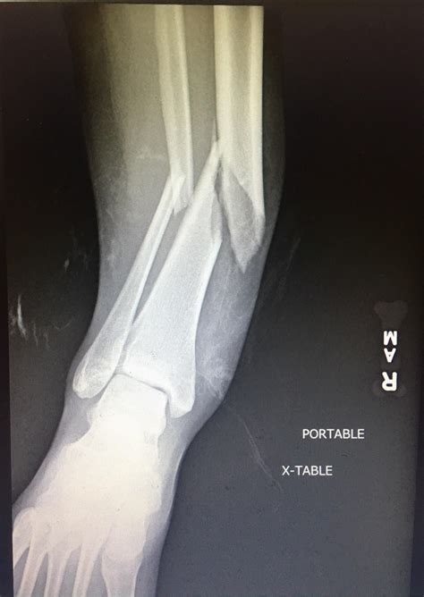 Tibia And Fibula Fractures Ankle Images And Photos Finder