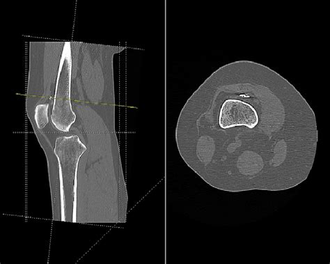 Ct Scan Of The Right Knee Showing The Endobutton In Suprapatellar Pouch