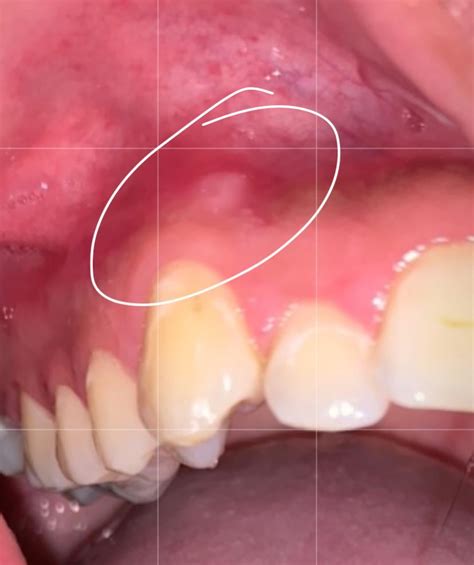 Hard Painless White Bump On Top Gum What Could It Be Rcankersores