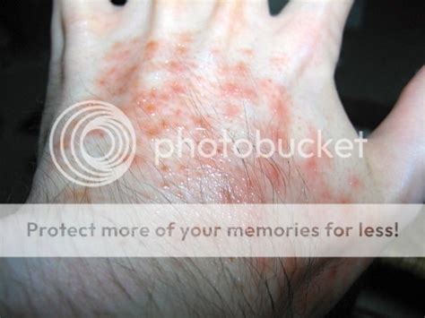 Random Rash On Arm Pictures Photos