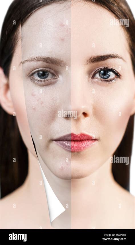 Layer With Bad Skin Unstick From Good Healthy Skin Stock Photo Alamy