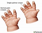 Single palmar crease: MedlinePlus Medical Encyclopedia Image